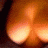 Lupus